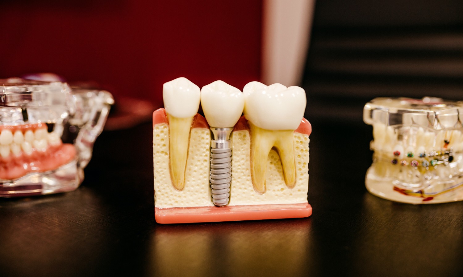 dental molds lined up on a table